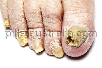 fungal infections